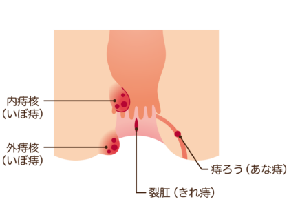 肛門疾患