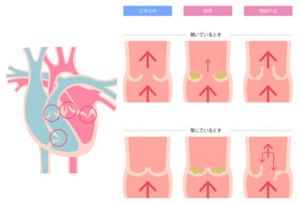 弁膜症