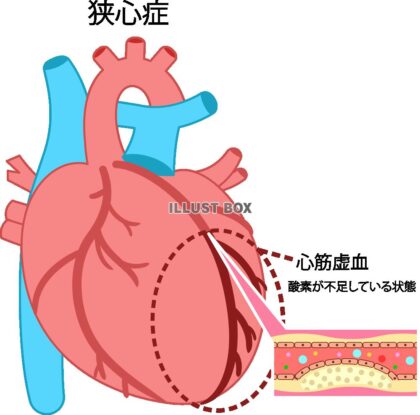 狭心症